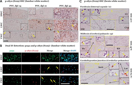 Immunostaining of phospho-alpha synuclein (S129) within white matter regions of PFF aSyn injected M83+\+ mice. (A) Representative images showing p-aSyn (S129) IHC in lumbar white matter columns of PFF aSyn injected cohorts- dpi 14, dpi 21 and dpi 45 (dpi, days post-injection; DWC, dorsal white column; LWC, lateral white column; VWC, ventral white column; 20× magnified views, scale bar = 50 µm). Yellow arrows in the insets point to select instances of p-aSyn (S129) positive oligodendroglial cells. Primary antibody in A: p-aSyn (S129)- 11A5. (B) Representative images showing dual immunofluorescence detection of oligodendroglial marker (p25a, in green) and p-aSyn (S129, in red) in lumbar white matter of PFF aSyn injected cohort- dpi 45 (dpi, days post-injection; DWC, dorsal white column; LWC, lateral white column; VWC, ventral white column; 40× magnified views, scale bar = 50 µm). Merge images with DAPI (nuclear stain, in blue) are also shown. Primary antibodies in 4B: p-aSyn (S129)- 11A5 and p25a. (C) Representative images showing p-aSyn (S129) IHC in indicated white matter tracts in brains of PFF aSyn injected cohort- dpi 45 (5× low magnification views, and areas highlighted within the yellow rectangles are shown as 20× magnified views, scale bar = 100 µm). Yellow arrows in the insets point to select instances of p-aSyn (S129) positive oligodendroglial cells in the white matter tracts. Bregma co-ordinates (in mm) are derived from Paxinos and Franklin’s (Fourth edition 2013, Elsevier) with the following topographical landmarks: (Forebrain) ic, internal capsule; LV, lateral ventricle; CA3, cornu ammonis area 3 of hippocampal formation; DM, dorsomedial hypothalamus; (Midbrain) cp, cerebral penduncle; tfp, transverse pontine fibres; ml, medial leminiscus; RN, red nucleus; Pn, pontine nuclei; (Cerebellopontine junction) mcp, middle cerebellar penduncle; icp, inferior cerebellar peduncle; 4V, fourth ventricle; IntA, interposed cerebellar nuclei; Lat, lateral cerebellar nuclei). Primary antibody in C: p-aSyn (S129)- 11A5.