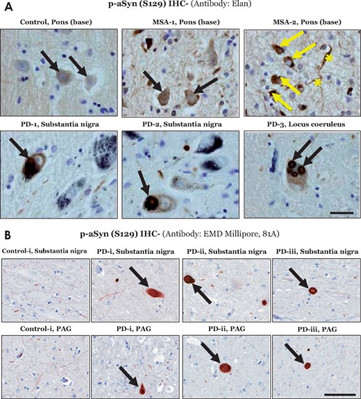 Immunostaining of phospho-alpha synuclein (p-aSyn, S129) in post-mortem human brain sections. (A) Representative images showing p-aSyn (S129) immunostaining by the Elan antibody in a control (base of pons- basis pontis), two multiple system atrophy cases (MSA, #1–2, Supplementary Table S1; base of pons) and three Parkinson disease cases (#1–3, Supplementary Table S1; substantia nigra and locus coeruleus). The black arrows indicate neuronal p-aSyn (S129) inclusions in both Parkinson disease and MSA cases. In MSA-2, glial p-aSyn (S129) inclusions are indicated by the yellow arrows, while the fibre tract staining is indicated by the yellow asterisks (scale bar = 20 µm). (B) Representative images showing p-aSyn (S129) immunostaining by the EMD Millipore antibody 81A in the midbrain substantia nigra and periaqueductal grey-PAG of a control (#i, Supplementary Table S2) and three Parkinson disease cases (#i–iii, Supplementary Table S2). The black arrows indicate Lewy body pathology in Parkinson disease (scale bar = 100 µm). Also see Supplementary Fig. 6.