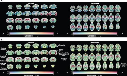 In vivo MRI reveals regional brain volume loss and ventricular enlargement in 7-month-old TDP-43Q331K/Q331K knock-in mice. (A) A map of voxel-wise differences in volume between 7-month-old +/+ and Q331K/Q331K mice calculated from in vivo MR images, overlaid on the T1-weighted study-specific template. The map is displayed in the coronal plane (rostral-caudal) and the transverse plane (ventral–dorsal). The R and L indicate the right and left sides of the mouse. The colours of the overlay indicate the percent volume difference (cool colours indicate reduced volume in Q331K/Q331K mice compared to +/+ mice), and the opacity of the overlay indicates the significance of the volume difference (regions where the FWE-corrected P > 0.5 are completely transparent, and regions where the FWE-corrected P = 0 completely opaque). Black contours demarcate regions where the FWE-corrected P < 0.05. (B) A similar map as in (A) but showing differences in the DSURQE atlas ROI volumes. Black contours demarcate ROIs where the false discovery rate-corrected P < 0.05. ROIs of particular interest are annotated.