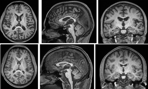 Structural T1-weighted MRIs showing affected brothers BI (top row) at age 28 and BII (bottom row) at age 25. Mild atrophy is present only in the older brother with more advanced disease; atrophy was still minimal at autopsy at age 29.