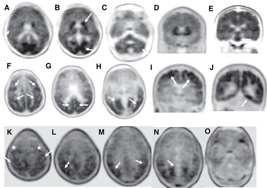 Amyloid and tau PET images in affected family members. (1. Top row) Florbetapir PET images of Case BII in axial (A–C) and coronal (D and E) planes showing loss of grey–white matter differentiation (A, arrow) with multiple areas of high cortical uptake particularly in the posterior cingulate gyri, parietal and occipital lobes with very high uptake in the basal ganglia and brainstem (B and E, arrows). Patchy uptake is also seen in the grey matter of the cerebellum (C, arrow). (2. Middle row) Flortaucipir PET images of case BI; axial (F–H) and coronal (I and J) planes show extensive tau uptake in the neocortical regions. There are bilateral frontal and parietal uptakes including the peri-Rolandic regions (F and I, arrows), posterior cingulate gyri (G, arrow) and premotor cortices (F, top arrows). There is also extensive binding in the lateral and medial occipital areas bilaterally (G and J, arrows). (3. Bottom row) Flortaucipir PET-CT images of case BII; axial images showing patchy uptake in neocortical regions, including parietal, occipital, posterolateral temporal lobes (L–O, arrows) and also in the peri-Rolandic regions (K, arrows) and premotor cortices (K, white stars). No cerebellar uptake identified.