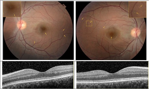 Colour fundus photograph and optical coherence tomography (OCT) of the left (left panels) and right eyes (right panels) of subject BII. The optic disc appears with sharp margins and normal colour in both eyes. The retinal vessels are largely unremarkable except for possibly mild tortuosity and focal areas of attenuation of the large calibre retinal arteries in each eye. The fundus pigmentation is notable for small (∼25 microns), focal lesions in each eye some of which are denoted by the small arrows. Inset panels in the fundus photographs demonstrate high magnification of a region with the lesions. OCT sections through the fovea of each are illustrated. There was no evidence of retinal pigment epithelium or intraretinal pathology on any OCT section that corresponded with lesions on fundus photography.