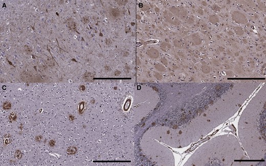 Immunohistochemistry on neuropathological specimens from the patient with the F388S PSEN1 mutation. (A) The hippocampus shows abundant neurofibrillary tangles and neuritic plaques on tau (AT8) immunohistochemistry (scale bar = 300 μm). (B) Florid amyloid plaques with ‘cotton wool’ morphology in the frontal cortex on Aβ42 immunostain (300 μm). (D) Immunohistochemistry for Aβ40 highlights severe CAA in the occipital cortex as well as scattered plaques with dense cores (300 μm). (D) Many amyloid plaques as well as CAA seen in the cerebellar cortex on Aβ42 immunostain (scale bar = 600 μm).