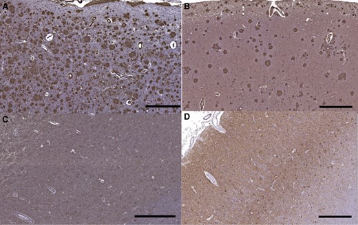 Immunohistochemistry of motor cortex in the patient with the F388S PSEN1 mutation and in an autosomal dominant Alzheimer’s disease control without spastic paraparesis. (A) Motor cortex shows amyloid plaques seen with Aβ42 immunostain in the index case with the F388S mutation in PSEN1 and (B) a patient with the V717I mutation in APP that does not cause SP (scale bar = 500 μm), (C) tau pathology in motor cortex with the F388S mutation (scale bar = 600 μm) and (D) with the V717I mutation (scale bar = 500 μm), tau pathology is not obviously more severe in the patient with SP.