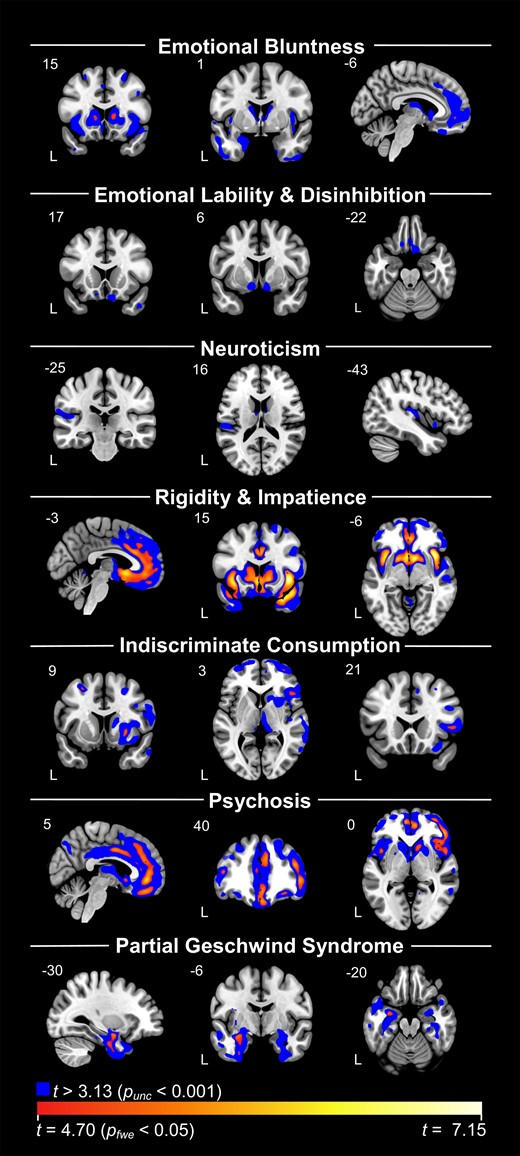VBM analyses with each component across diagnosis. Blue represents results at uncorrected P < 0.001 levels. Red/yellow/white spectrum represents findings that survived FWE corrections at P < 0.05. Components 2 and 3 did not have any findings at corrected levels. Each analysis controlled for total intracranial volume, age, sex and scanner type (dummy coded).