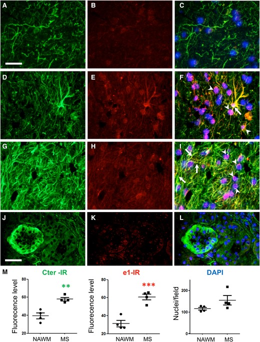 Increased Kir4.1 immunoreactivity in multiple sclerosis brain. First column, Cter Kir4-1 immunoreactivity (green). Second column, immunoreactivity with mouse anti-e1 serum (red). Representative photographs obtained from the different samples in the green or red channel were taken at the same exposure time. Third column, merged signals with DAPI stain and with enhanced red channel contrast to better visualize co-localization. (A–C) Subcortical white matter from a control brain. Kir4.1 is mainly detected on glial fibres using anti-Cter antibody whereas almost no signal is detected with the mouse anti-e1 serum. (D–F) Subcortical white matter active lesion with increased Kir4.1 immunoreactivity in glial fibres. An immunoreactive signal on glial cells with astrocytic morphology (arrow) and around the nuclei of oligodendrocyte-like cells (arrowheads) is also detected with the mouse anti-e1 serum. (G–I) Another subcortical white matter active lesion with high Kir4.1 immunoreactivity on glial fibres. Immunoreactive signals on glial fibres (arrows) and around the nuclei of oligodendrocyte-like cells (arrowheads) are also shown with mouse anti-e1 serum. Scale bar A–I, 40 µm. (J–L) Cortical kidney from a patient with chronic tubule interstitial nephritis. Kir4.1 expression by a distal tubule is well detected by the Cter antibody whereas the anti-e1 mouse serum gives barely detectable signal in the same tubule. Scale bar J–L, 40 µm. (M) Quantification of immunofluorescence signals from four different NAWM samples (circles) versus four different active white matter lesions (squares) from postmortem subcortical tissues. Two-tailed unpaired t-test: **, P < 0.01 (t = 4.896, df = 6); ***, P < 0.001 (t = 6.134, df = 6).