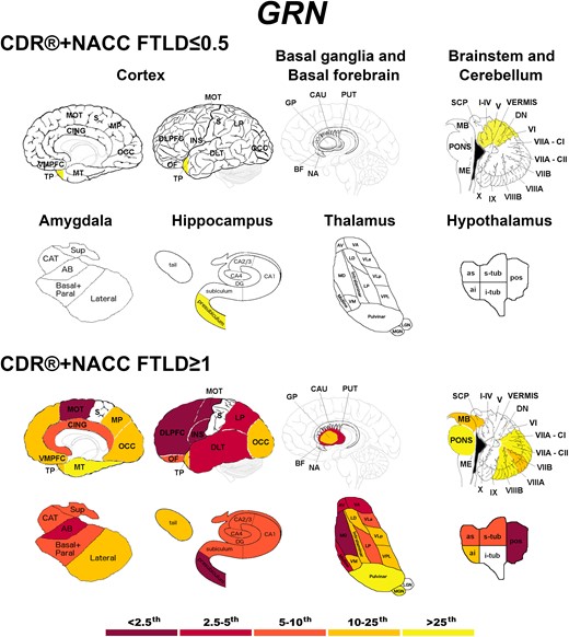 Pattern of grey matter involvement in GRN for the stages defined by CDR®+NACC FTLD global scores. The color map indicates the percentile corresponding to the mean w-scores in each group (GRN ≤0.5/≥1: n = 130/30), when these were statistically abnormal (i.e. significantly different from 0, t-test) when compared to controls (n = 240).