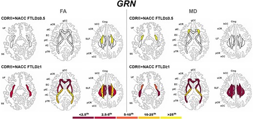 Pattern of white matter involvement in GRN for the stages defined by CDR®+NACC FTLD global scores. FA indexes are reported on the left side of the figure, while MD on the right. The color map indicates the percentile corresponding to the mean w-scores in each group (GRN ≤0.5/≥1: n = 130/30), when these were statistically abnormal (i.e. significantly different from 0, t-test) when compared to controls (n = 240).