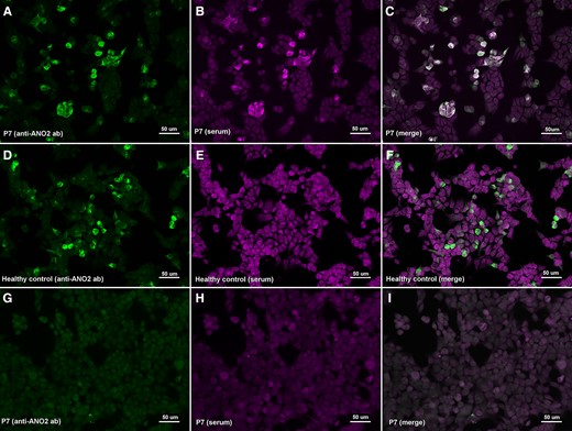 Immunocytochemistry of anti-ANO2 antibodies. HEK293 cells transfected with mammalian-expression vectors encoding human ANO2 using Lipofectamine 2000 (A–F) or HEK293 cells non-transfected (G–I); double-stained with serum (B, E, H) and with commercial antibody against ANO2 (A, D, G). MS patient’s IgG bind to transfected cells (B) and colocalize with ANO2 ab (C); in contrast with the healthy control (E) that does not show any reactivity against ANO2 antibodies.