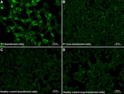 Immunocytochemistry of anti-FLOT1/2 antibodies (commercial slides). Commercial biochips (Euroimmun) containing FLOT-1/2 transfected HEK293 cells (A, C) or non-transfected HEK293 cells (B, D); incubated with serum from MS Patient 1 (A, B) and from a healthy donor (C, D). Patient 1 showed strong IgG reactivity against co-transfected cells (A) in comparison with non-transfected cells (B) and with the negative control (C).