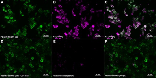 Immunocytochemistry of anti-FLOT1/2 antibodies (in house transfection). HEK293 cells co-transfected with mammalian-expression vectors encoding human FLOT1 and FLOT2 using Lipofectamine 2000; double-stained with serum (B, E) and with commercial antibody against FLOT1 (A, D). MS patient’s IgG bind to co-transfected cells (B) and colocalize with FLOT1 ab (C); in contrast with the healthy control (E) that doesn’t show any reactivity against FLOT-1/2 antibodies (F).