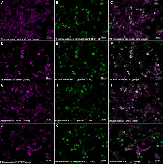 Immunoadsorption of anti-FLOT1/2 antibodies. HEK293 cells co-transfected with mammalian-expression vectors encoding human FLOT1 and FLOT2 double-stained with serum immunoadsorbed with non-transfected cells (A), FLOT1-transfected cells (D), FLOT2-transfected cells (G) or FLOT1 and FLOT2 co-transfected cells (J); and with commercial antibody against FLOT1 (B, E, K) or FLOT2 (H). Reactivity against the FLOT-1/2 complex was lost after serum pre-adsorption with HEK cells co-expressing FLOT1 and FLOT2 (L), but not after pre-adsorption with cells transfected with FLOT1 (F) or FLOT2 (I) alone or with non-transfected HEK cells (C).