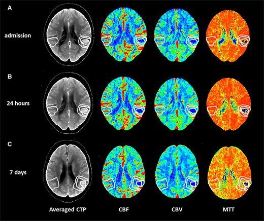 Perfusion mapping of acute spontaneous intracerebral haemorrhage. Computed tomography perfusion in a patient with acute spontaneous intracerebral haemorrhage located in the left temporal and parietal lobes performed at admission (A), at 24 h (B) and at 7 days (C) on averaged computed tomography perfusion images (averaged CTP). CBF, cerebral blood flow; CBV, cerebral blood volume; MTT, mean transit time.