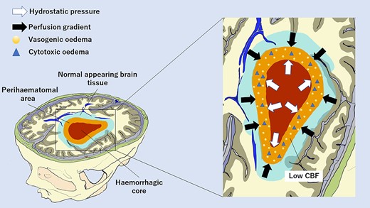 Hypothetical hydrostatic and perfusion factors promoting delayed PHO at 7 days after intracerebral haemorrhage. The hydrostatic pressure gradient between the HC and perihaematomal area is due to the high pressure of the clot that is not counteracted by the low pressure of the perihaematomal area. The perfusion gradient between NA brain tissue and perihaematomal area is created by normal CBF levels of non-injured tissue opposed to low perihaemorragic CBF values. Both mechanisms contribute to water migration from intravascular to extracellular spaces. This is facilitated by also the BBB breakdown caused by the extension of perihaematomal cytotoxic oedema to vessel wall endothelial cells. CBF, cerebral blood flow.