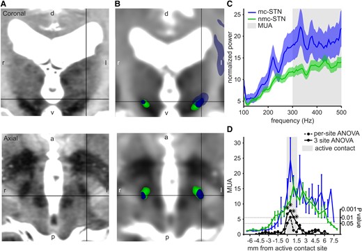 Connectivity-derived STN segmentation and MER analysis. (A) 7 T T2 MRI of an example patient showing the STN in coronal and axial planes. d: dorsal, v: ventral, l: left, r: right. (B) 7 T T2 MRI registered to the diffusion MRI and the connectivity-derived STN segmentation; motor-connected STN (mc-STN, blue) with projections to the cortical motor areas (transparent blue) and non-motor-connected STN (nmc-STN, green) in the same example patient. The black pointer indicates the dorsal STN motor subdivision. Images are aligned to the commissural line. (C) Baseline-corrected power spectrum for mc-STN and nmc-STN. MUA calculated as mean power >300 Hz. The solid line showing mean and the shading showing standard error. (D) Mean MUA at each recording site, aligned to the active location site (grey shading). Mc-STN in blue and nmc-STN in green. The error bars show standard error. Stippled black line: 1-log P-value from ANOVA calculated at each site. The solid black line, which is the same for ANOVA, calculated in a three-site sliding window. The stars denote significant differences after multiple comparison correction. mc, motor-connected; nmc, non-motor-connected; STN, subthalamic nucleus; MER, microelectrode recording; MUA, multi-unit activity. Sample size MUA: total recordings n = 149 (25 patients, 3 recordings per hemisphere covering the active DBS electrode contact site, for 1 patient the most dorsal active contact site was used, which resulted in 2 recordings for that hemisphere); motor-connected STN recordings n = 27; non-motor-connected STN recordings n = 122.