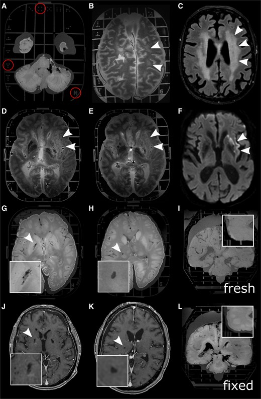 Whole-brain MRI using the Brainbox. the Brainbox has an imprinted 3D coordinate system with Latin letters in Z direction and unequivocal dots in X and Y direction (A). Whole-brain post-mortem MRI from a patient with X-linked adrenoleukodystrophy shows T2w hyperintensities in the deep white matter (B, white arrowheads), similar to the premortem T2w imaging (C). T2w hyperintense, i.e. demarcated stroke in the vascular territory of the middle cerebral artery affecting the basal ganglia, the internal capsule and the insula, in fresh (D, white arrowheads) and after 3 weeks of formaldehyde fixation (E), similar to the diffusion restriction in premortem MRI (F). Also, smaller imaging features such as EPVS in the basal ganglia (G and J, premortem T1w image) or a lacunar stroke (H and K, premortem T1w scan) are conspicuous using our high-resolution MRI protocol of the whole human brain in the Brainbox (inlets with higher magnification). Brains which were fixed for 2–3 weeks show volume decrease (inlets with higher magnification of the temporal region) (I and L). Abbreviations: MRI, magnetic resonance imaging; T1w, T1-weighted; T2; T2-weighted.