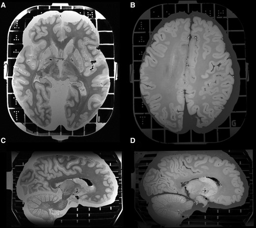 High-resolution brain MRI from a COVID-19 donor using the Brainbox. High-resolution MRI of a brain from a COVID-19 donor, employing gradient echo magnetization transfer imaging (A and C) and gradient echo quantitative susceptibility mapping (B and D). Nominal resolution: 0.4 mm isotropic.