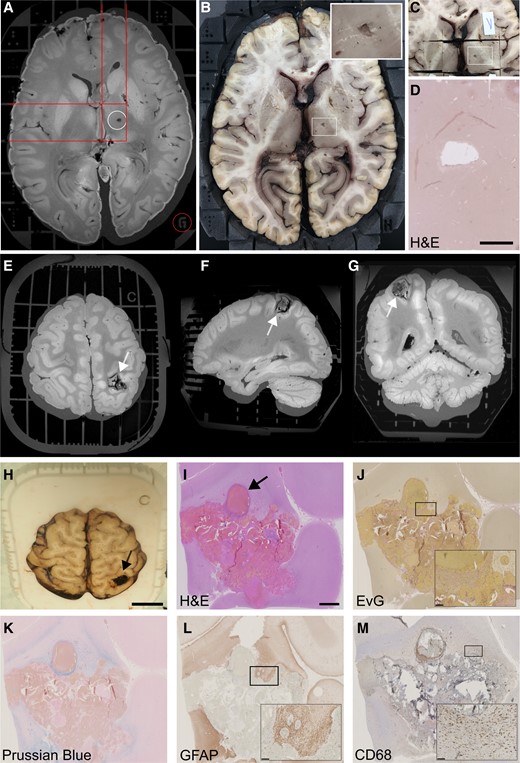 Imaging to histopathology correlation using the Brainbox. The Brainbox can facilitate the correlation of MRI features to histopathology. (A) A VOI is identified on the MR image, e.g. a hypointense ovoid lesion in the right internal capsule, corresponding to either an enlarged perivascular space (EPVS) or a lacunar stroke (top/white circle). The 3D coordinate system is used to identify its location in relation to the Brainbox (red lines and bottom/red circle). (B) Identification of the lesion in the macroscopic view of the brain using the coordinate system (white rectangle labelling VOI, close-up in the top right corner). (C) Cutting a tissue block. (D) Histopathological work-up using H&E staining and showing a tissue defect, consistent with a chronic lacunar stroke (scale bar: 2 mm). (E-G) Unclear haemorrhagic lesion in the right angular gyrus (white arrow). Note the ribbon-shaped artefact at the grey-white matter junction can stem from relatively short brain fixation in formaldehyde. (H) This unclear lesion was correlated to its tissue substrate using the Brainbox (scale bar: 2 cm). (I) Histopathology using H&E staining reveals a cavernous haemangioma with abnormal blood vessels (black arrow, scale bar: 2 mm). (J) Elastica van Gieson (EvG) stain highlights cavernous dilatations and thickened wall in places (inset, scale bar: 250 µm) (K) Iron staining using Prussian blue demonstrates hemosiderin in perilesional old micro-haemorrhages (scale bar: 250 µm). (L and M) Immunohistochemistry demonstrates fibrillary GFAP-positive astrogliosis (L) and CD68 in reactive microglia (M) (scale bar: A: 2 cm, I-M 2 mm, insets: 250 µm). Abbreviations: EvG, Elastica van Gieson; GFAP, glial fibrillary acidic protein; H&E, haematoxylin and eosin; MRI, magnetic resonance imaging.
