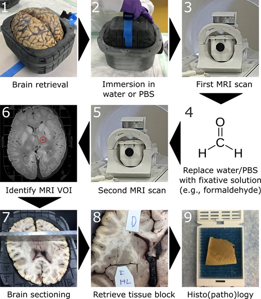 Pipeline for MRI-histopathology correlation using the Brainbox. 1: The brain is retrieved upon autopsy and mounted in the brain holder (inner compartment) of the Brainbox; 2: The brain holder is inserted into the tank filled with an aqueous medium, e.g. water or PBS; 3: First MRI scan of the brain using a 20-channel head coil; 4: Replace aqueous medium with fixative solution, e.g. 10% neutral-buffered formalin. Of note, the medium can be changed by pouring out the medium and filling the tank with another medium, i.e. the brain position within the brain holder remains unchanged. The brain can be soaked/stored until acquisition of next MRI; 5: Second MRI scan; 6: Identification of a VOI within the MR images, e.g. a presumable lacunar stroke. Reference points for later tissue retrieval can be identified on the built-in 3D coordinate system; 7: Axial/transversal sectioning of the brain according to the identified coordinates; 8: Retrieval of tissue block of interest; 9: Histo(patho)logical processing of tissue block, e.g. embedding in paraffin. Abbreviations: MRI, magnetic resonance imaging; PBS, phosphate-buffered saline; VOI, volume of interest.