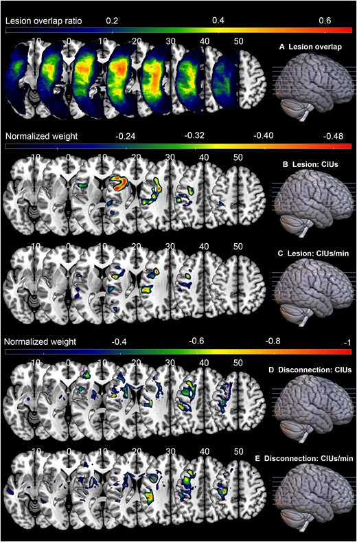 Lesion correlates of CIU measures. (A) Lesion overlay map (n = 66). (B) Lesion LSM solution for #CIUs. (C) Lesion LSM solution for CIUs/min. (D) Disconnection analysis result for #CIUs. (E) Disconnection analysis result for CIUs/min. The lesion and disconnection LSM used participants’ lesion maps and inferential disconnection map (binarized by disconnection proportion of 0.5), respectively to predict CIU measures. Total lesion size was regressed out from the symptom score. Values in the brain map correspond to standardized weights, indicating the contribution of each voxel to the model. Only voxels with normalized weights greater than 0.1 are shown. Warmer colours represent stronger contributions. LSM analyses for %CIUs did not produce a statistically significant solution, so they are not included here.