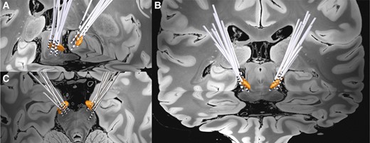Grouped STN-DBS electrode localization. Bilateral DBS electrodes of 15 patients are reconstructed and shown with bilateral STN (3D object) in (A) oblique, (B) coronal, and (C) axial view.