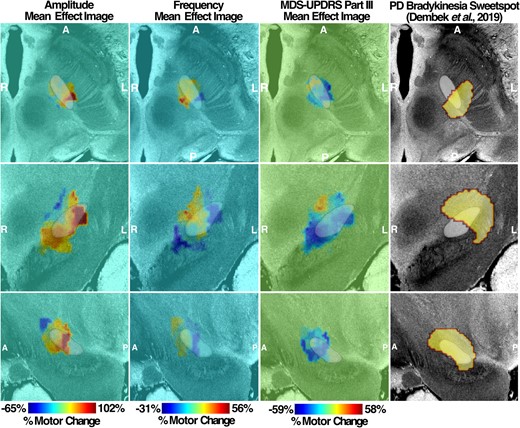 Left MEI of right-hand LMC motor features. Amplitude and frequency MEIs are visualized in the first and second columns, respectively, of each stimulation side with overlayed STN (white). The relative warmth or coolness of colouration represents a correlation with an increase or decrease, respectively, in motor features relative to the mean effect. The third column represents MEI of the MDS-UPDRS III changes from our study cohort and the previously published bradykinesia clinical ‘sweetspot’ on the fourth column. A, anterior; P, posterior; R, right; L, left.