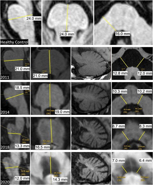 Pons and MCP measures in MSA-C.Top row: sagittal measurements (left image) and axial measurements (middle and right images) of the AP Pons diameter and transverse MCP diameters in a healthy control. Bottom four rows: sequential images from 2011 to 2020 in a patient with MSA-C showing progressive pons and cerebellar atrophy. Note that the AP Pons diameter was ascertained from the axial plane of section only in 2011. In subsequent scans, the axial plane was not perpendicular to the long axis of the brainstem and so the more accurate measure was derived from the sagittal images that was at or close to the midline as seen in the corresponding axial sections. The parasagittal views of the cerebellar hemisphere show the progressive cerebellar atrophy with shrinkage of the entire hemisphere, loss of the corpus medullare and prominence of the cerebellar folia. AP, anteroposterior; MCP, middle cerebellar peduncle; MSA-C, multiple system atrophy of the cerebellar type. Measurements in small text from screen shots of the patient’s MRI are shown in black font on white background for readability.
