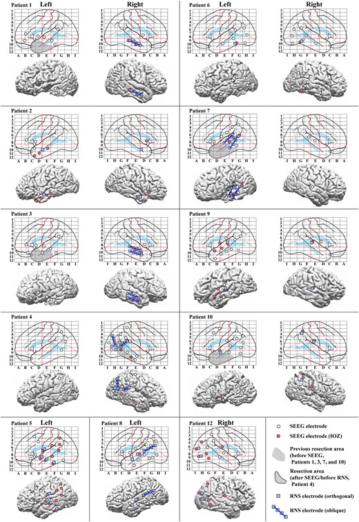 Configurations of SEEG and RNS electrodes. Configurations of SEEG and RNS electrodes are shown in anatomical labels in Talairach space (top for each patient) and on a presurgical 3D-MRI (bottom for each patient), except that for Patient 11 whose is shown in Fig. 3. IOZs were defined by the experts’ review of ictal SEEG. The red lines on the electrode maps indicate the vertical line passing the anterior commissure (VAC line, between D and E), the vertical line passing the posterior commissure (VPC line, between E and F) and the AC–PC line (a horizontal line between 8 and 9) in Talairach space to visualize and standardize the electrode locations of SEEG. Abbreviations: the conventions are same as for Fig. 1.