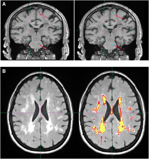 Examples of radiological finding quantification from 2 CADASIL patients. (A) Identification of WM ePVS in the coronal plane. Arrows point to visually inspected ePVS. The right image shows the result after the identification algorithm has been applied. The blue colour masking indicates autoidentified ePVS. (B) WMH masking in the axial plane. The yellow colour indicates high confidence of auto-identified WMH lesions, and the red colour indicates lower confidence of autoidentified WMH lesions.