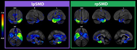 Pattern of FDG-PET hypometabolism in SMD variants. The CortexIDs show bilateral yet markedly asymmetric hypometabolism of the anterolateral and medial temporal lobes. The hypometabolism is left lateralized in lpSMD and right lateralized in rpSMD. The pattern of hypometabolism in the predominantly involved hemisphere is reminiscent of a ‘boxing glove’. Ant, anterior; Inf, inferior; L, left; lpSMD, left-predominant semantic dementia; R, right; rpSMD, right-predominant semantic dementia.
