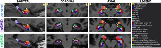 Hippocampal subfield segmentation. The figure shows representative T1-weighted MRI sagittal, coronal, and axial images for patients from the control, lpSMD, and rpSMD groups with overlying FreeSurfer 7-based segmentation of the subfields. Images are obtained using FreeSurfer Freeview tool. A, anterior; AAA, anterior amygdaloid area; GC-DG, dentate gyrus; HATA, hippocampal amygdaloid transition area; HP, hippocampus/hippocampal; L, left; lpSMD, left-predominant semantic dementia; P, posterior; R, right; rpSMD, right-predominant semantic dementia.