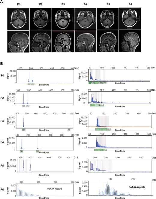 MRI and electropherograms of pathogenic expansion carriers. (A) The brain MRI of patients carried six patients with pathological expansions. (B) Electropherograms of patients with repeat expansions of tremor-associated STRs. STRs, short tandem repeats.