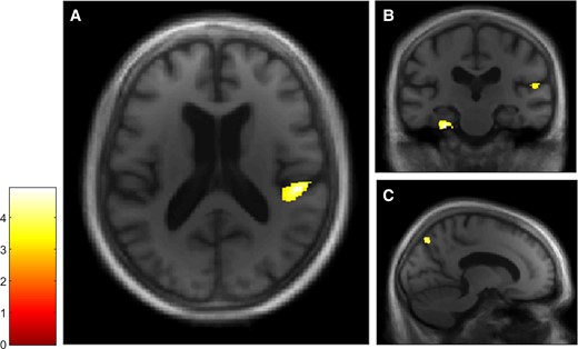 VBM analyses for the Autobiographical Interview free recall condition in the dementia with Lewy bodies group. Multiple linear regression was used to obtain correlation for Autobiographical Interview free recall score and GM volume in patients with dementia with Lewy bodies (n = 20). GM volumes within right posterior insula (A and B), left parahippocampal gyrus and right temporoparietal junction (B) and right precuneus (C) are positively correlated with the free recall score on the Autobiographical Interview, using a threshold of P = 0.005 uncorrected, including age, gender, TIV and MMSE score as nuisance covariates (k = 50).