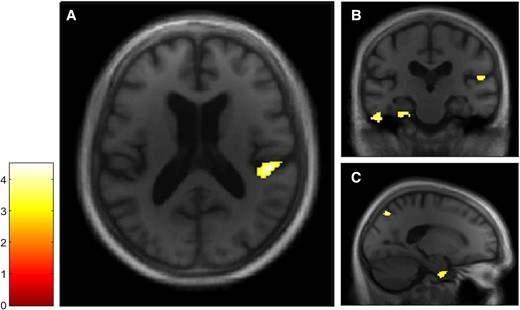 VBM analyses for the Autobiographical Interview probed recall condition in the dementia with Lewy bodies group. Multiple linear regression was used to obtain correlation for Autobiographical Interview probed recall score and GM volume in patients with dementia with Lewy bodies (n = 20). GM volumes within right posterior insula (A and B), left inferior temporal and parahippocampal gyri (B) and right precuneus and parahippocampal gyrus (C) are positively correlated with the probed recall score on the Autobiographical Interview, using a threshold of P = 0.005 uncorrected, including age, gender, TIV and MMSE score as nuisance covariates (k = 50).