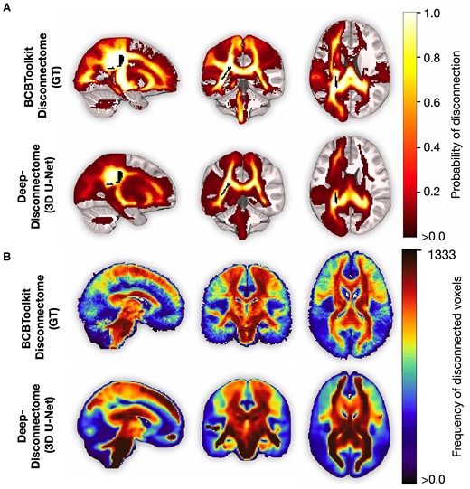Deep-disconnectomes accurately resemble the conventional disconnectomes. (A) Visual comparison of a representative (N = 1) out-of-sample patient conventional disconnectome obtained from the BCBToolkit software and used as the GT in the model training (top) with its 3D U-Net predicted deep-disconnectome (bottom). (B) Frequency maps of the disconnected voxels obtained by comparing binarized conventional (N = 1333) and binarized deep-disconnectomes (N = 1333) (dataset 2). Higher values indicate the voxels to be disconnected more frequently, while lower values indicate less frequent disconnections of these particular voxels.