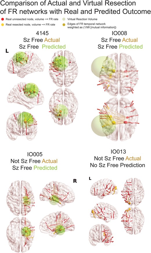 Illustration of FR networks and real and virtual resections. In the four patients, the sizes of red (unresected) and yellow (resected) nodes (i.e. SEEG electrode contacts) are proportional to the relative FR rate. The edges (pale yellow), connecting the nodes to one another, are weighted in size by the inverse of the MI of FR temporal correlations between the two nodes. The green sphere denotes the borders of the virtual resection. The centre of the sphere is the node with most FR autonomy and/or highest FR rate and has a margin of 1 cm. The four FR metrics (FR RR, spatial FR net and temporal FR net-A, B) are derived from comparison of the sets of FR-generating contacts in and outside of the virtual resection sphere, and these factors are used by the SVM to predict virtual seizure (sz) freedom. If the SVM predicts non-seizure (non-sz) freedom, the virtual resection model iterates, and the virtual resection sphere may expand depending on whether the spatial location of the next top node that generates FR at higher rates and most autonomy is outside the sphere. In the case that the sphere expands, the new margins are extended by 1 cm. If the virtual resection includes three lobes, it is considered a failure. As shown, extension of the virtual resection sphere outside of the spatially sampled regions, and outside the brain, does not increase the number of nodes in the virtual resection set. Contralateral nodes within the virtual resection sphere are also excluded from the virtual resection set of nodes. For patients 4145 and IO008, who were rendered seizure free, the virtual resection that was predicted as sufficient for virtual seizure freedom included a set of nodes that partially overlaps with the set of resected nodes. In patient 4145, the contacts in the virtually resected set (red and yellow nodes within green sphere) were larger than the set of resected nodes (yellow nodes). In patient IO008, the difference between the set of nodes in the virtual resection and actual resection was smaller (see Table 3). Patient IO005 was not seizure free, but the virtual resection that predicted a seizure-free outcome was more posterior and included nodes with high FR rate and low MI edges. Patient IO013 was not seizure free, but the virtual resection did not produce seizure freedom because it required a resection of the occipital, parietal and temporal lobe.