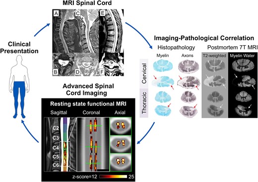 Spinal cord evaluation in multiple sclerosis: clinical and radiological ...