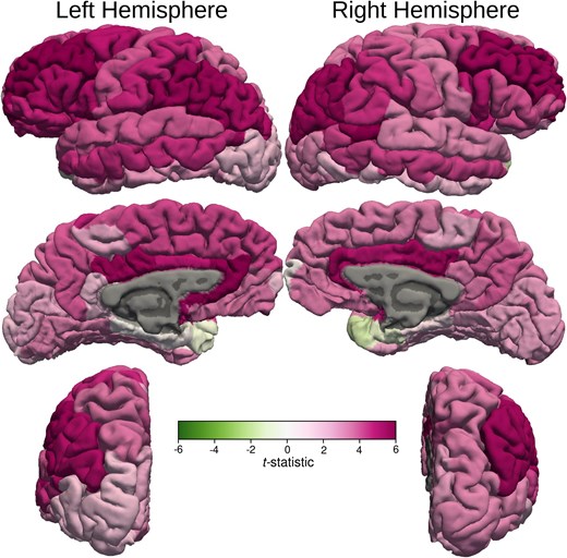 Cortical MD t-statistic displayed on cortical surfaces. t-statistic values of the cortical MD are displayed on cortical surfaces. The colour bar demonstrates the mapping of the t-statistic from green (Negative 6) to magenta (Positive 6) through varying shades. Darker shades of magenta in the middle frontal gyrus, precuneus, posterior aspect of the medial prefrontal cortex and cingulate gyri indicate maximum increase in MD compared with the healthy control subjects. The changes seen in frontal poles and temporal poles, entorhinal and parahippocampal gyri were not statistically significant.