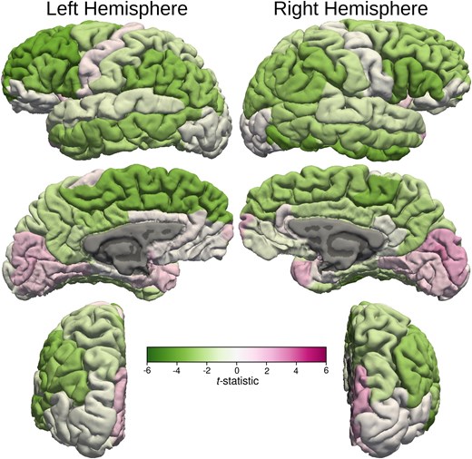 Cortical thickness t-statistic displayed on cortical surfaces. t-statistic values of the cortical thickness are displayed on cortical surfaces that demonstrate bilateral asymmetry. The colour bar demonstrates the mapping of the t-statistic from green (Negative 6) to magenta (Positive 6) through varying shades. Darker shades of green indicate statistically significant decrease in cortical thickness compared with the healthy control subjects in the left superior and inferior frontal, left paracentral lobule, left inferior parietal, left supra-marginal and middle temporal gyrus, right inferior frontal gyri, right paracentral lobule, right inferior parietal, right inferior temporal and right supra-marginal gyri. There was also a statistically significant increase in cortical thickness compared with the healthy control subjects in the right peri-calcarine cortex.