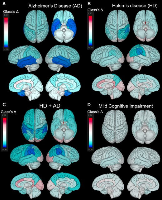 Superficial distribution of the mean Glass’s Δ. Superior, inferior, outer lateral, and inner lateral surface views showing the distribution of the mean Glass’s Δ in the Alzheimer’s disease (AD, N = 256) (A), Hakim’s disease (HD, N = 52) (B), HD with AD (HD + AD, N = 25) (C), and mild cognitive impairment groups (N = 163) (D).