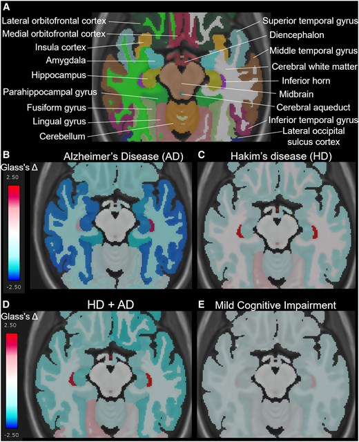 Mean Glass’s Δ on axial views surrounding the hippocampus and temporal lobe. A shows the names of each automatically segmented subregion observed within the cross-section. The mean Glass’s Δ in the Alzheimer’s disease (AD, N = 256) (B), Hakim’s disease (HD, N = 52) (C), HD with AD (HD + AD, N = 25) (D), and mild cognitive impairment groups (N = 163) (D).