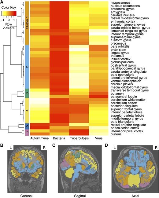 Hierarchical clustering results based on predictive performance of unimodal models using brain MRI. (A) The 43 brain regions were divided into 6 clusters. (B–D) Visualization of hierarchical clustering of each brain region overlaid on brain MRI images. (B) Coronal, (C) sagittal and (D) axial section. Hierarchical clustering was performed using an agglomerative approach with average linkage and Euclidean distance as the dissimilarity metric. Clustering was conducted on an internal dataset derived from the results of the MRI unimodal model. The dataset included autoimmune (n = 45), bacterial (n = 46), tuberculosis (n = 30) and viral (n = 170) cases.
