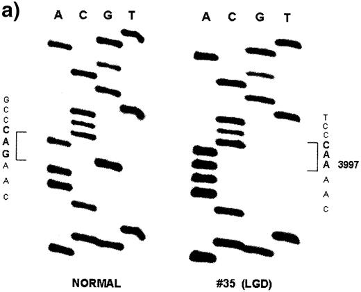  A representative sequencing autoradiogram for rat Apc mutations from ( a ) low grade dysplasia (LGD), ( b ) high grade dysplasia (HGD) and ( c ) invasive adenocarcinoma (CA). 