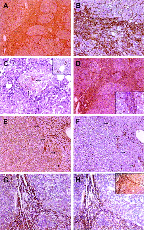  Immunohistochemistry of c-myc /TGF-α HCCs promoted by PB with β-catenin NAinv pattern. ( A ) Solid HCC displaying tumor invasion front (indicated by arrows). Magnification 40×. ( B ) β-Catenin neoplastic cells are characterized by a high nucleocytoplasmic ratio and smaller size as compared with adjacent tumor hepatocytes. Magnification 400×. ( C ) NAinv hepatocytes are negative for A6 immunostaining. Biliary epithelial cells (inset) and rare tumor cells (indicated by arrows) display A6 immunolabeling. Magnification 600×. ( D ) E-Cadherin cytoplasmic redistribution that co-localize with β-catenin NAinv positive hepatocytes [compare with β-catenin staining in (A)]. Magnification 40×. (Inset) E-Cadherin cytoplasmic immunolabeling is limited to the small cells at the invasion front, whereas the surrounding tumor cells retain E-cadherin membranous localization. Magnification 400×. ( E and F ) HCC displaying membranous β-catenin and E-cadherin immunoreactivity, respectively. Magnification 200×. ( G and H ) Co-localization of MMP-7, MUC1 and β-catenin (inset) immunostaining. Magnification 200×. Histochemical staining was performed on serial sections in (A) and (D), (E) and (F), (G), (H) and inset. Sections were counterstained with Gill's hematoxylin. 