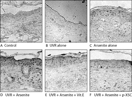  Vitamin E and p -XSC significantly inhibit 8-oxo-dG levels in skin of mice treated with UVR + arsenite. ( A ) Control; ( B ) UVR alone; ( C ) arsenite alone; ( D ) UVR + arsenite; ( E ) UVR + arsenite + vitamin E; and ( F ) UVR + arsenite + p -XSC. Each picture is representative of 10 samples. Magnification: 220× original. See online Supplementary material for a color version of this figure. 
