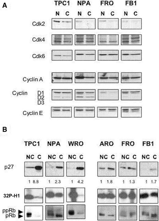  Induction of p27 kip1 expression, decrease of Cdk2 activity and reduction of pRb phosphorylation by contact inhibition correlates with sensitivity to contact-inhibition in thyroid cancer cells. ( A ) Western blot analysis of the effects of confluence on the expression of cyclins and Cdks in DTC (TPC-1, NPA) and ATC (FRO, FB1) cells. ( B ) Western blot analysis of p27 kip1 expression in DTC (TPC-1, NPA, WRO) and ATC (ARO, FRO, FB1) cells. Same lysates were immunoprecipitated with anti-Cdk2 antibodies (Cdk2 panels), and then assayed for kinase activity using recombinant histone H1 as substrate. pRB phosphorylation is maximal in subconfluent cells (lanes NC) and decreases completely in confluent TPC-1 and WRO cells or partially in NPA cells (lanes C). pRB and ppRB are indicated. NC, non-confluent; C, confluent. Red Ponceau staining of the filters was performed in every experiment to ensure uniform protein loading and integrity. 