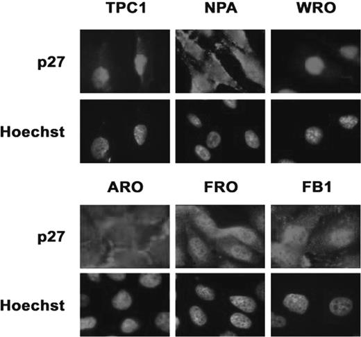  Immunofluorescence analysis of p27 kip1 localization in thyroid carcinoma cell lines. TPC-1, NPA, WRO, ARO, FRO and FB1 cells were grown to confluence on coverslips, fixed in 3% paraformaldehyde and permeabilized with 0.2% Triton X100. p27 kip1 -positive cells were identified using Texas-Red-conjugated secondary antibodies. Cell nuclei were identified by Hoechst staining. Fluorescence was visualized with a Zeiss 140 epifluorescent microscope. Magnification, ×100. The exposition time for TPC-1 and WRO was 5-fold shorter than the exposition time used for the remaining cells. See online Supplementary material for a colour version of this figure. 
