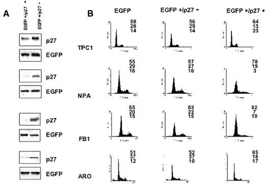  Expression of p27 kip1 is able to induce growth arrest in proliferating thyroid cancer cells. ( A ) Expression of HA-p27 kip1 in TPC-1, NPA, FB1 and ARO cells. Cells (1–3 × 10 6 cells/10 cm dish) were cotransfected with 5 µg of pfEGFP and 10 µg of pcDNA3 vectors expressing wild-type HA-p27 kip1 . Forty-eight hours after the transfection, cells were lysed in extraction buffer and the expressed HA- p27 kip1 proteins were detected by immunoblotting using anti-p27 kip1 . Controls represent mock transfections using pcDNA3 vector in place of HA-p27 kip1 . ( B ) Flow cytometry analysis. Left column: cells transfected with pfEGFP and control pcDNA3 vector. Middle column: cells transfected with pfEGFP and HA-p27 kip1 ; cell cycle profile is relative to cells sorted for being negative for fEGFP (and HA-p27 kip1 ). Right column: cells transfected with fEGFP and p27 kip1 ; cell cycle profile is relative to cells sorted for being positive for fEGFP (and HA-p27 kip1 ). 