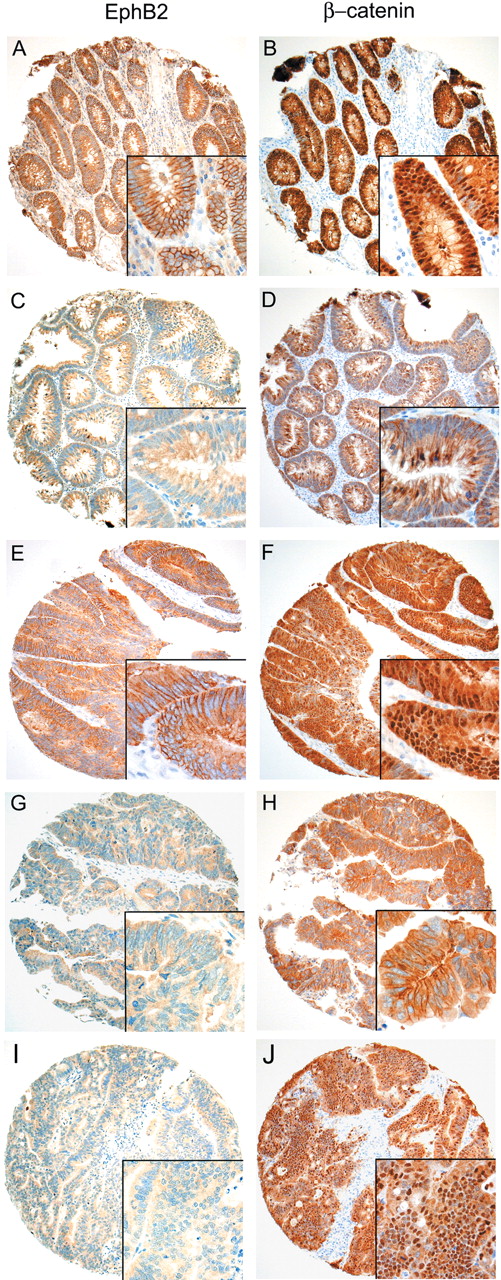  Expression of EphB2 and β-catenin in representative colorectal adenomas and carcinomas on a TMA. Insets depict the corresponding high power view. ( A – D ) Representative colorectal adenomas with (A) and without (C) membranous EphB2 expression. ( E – J ) Representative colorectal carcinomas with ( E ) and without ( G and I ) membranous EphB2 expression. Staining for β-catenin (right column) shows aberrant nuclear expression in the EphB2 positive tumours ( B and F ). Whilst some EphB2 negative cases demonstrate predominantly membranous β-catenin expression ( D and H ), there is clear-cut aberrant nuclear β-catenin in other cases ( J ). 