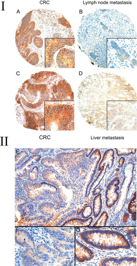  (I) Expression of EphB2 in colorectal carcinomas and their corresponding lymph node or liver metastases. Strong membrane expression of EphB2 is noted in a colorectal carcinoma ( A ) but absent in its lymph node metastases ( B ). Strong expression of EphB2 in another colorectal carcinoma ( C ) but absent in its liver metastases ( D ). (II) Expression of EphB2 in adenoma with malignant change arising from the colon. ( E ) The adenoma part (right field) shows strong membranous EphB2 expression but the invasive part (left field) shows no expression. The insets in the lower field depict high power view of the corresponding invasive ( F ) and adenoma ( G ) parts. 